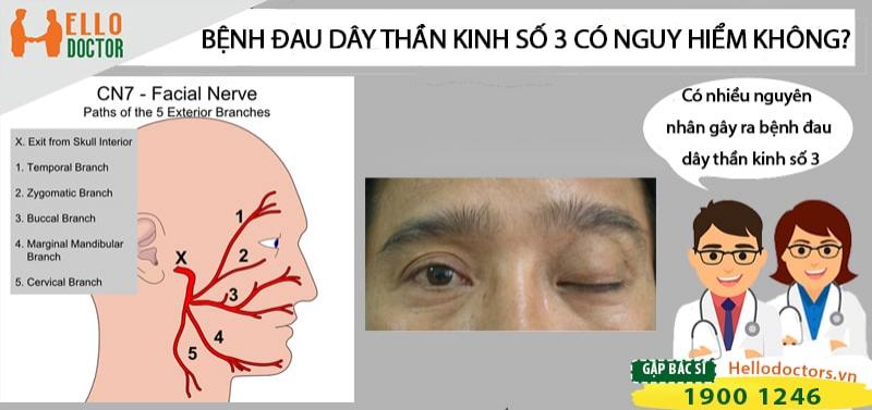 Hỏi đáp: Bệnh đau dây thần kinh số 3 có nguy hiểm không?
