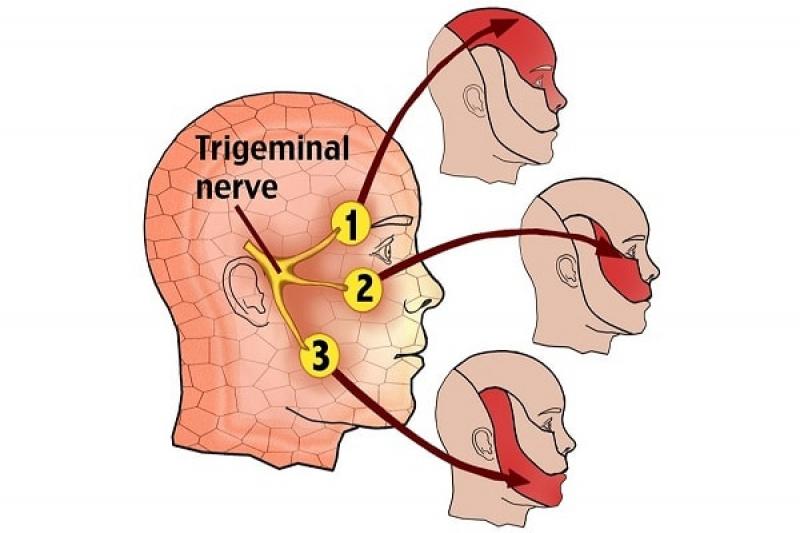 Các cách điều trị bệnh đau dây thần kinh số V