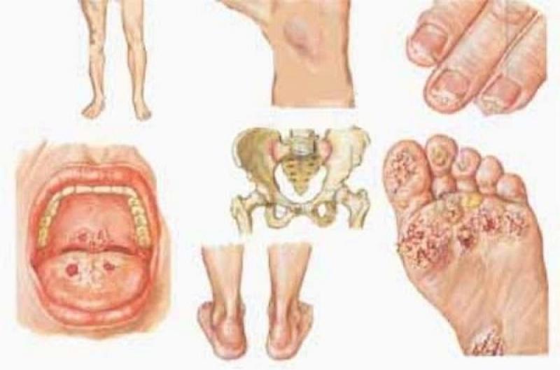 Làm thế nào để nhận biết mình đã bị nhiễm HIV?