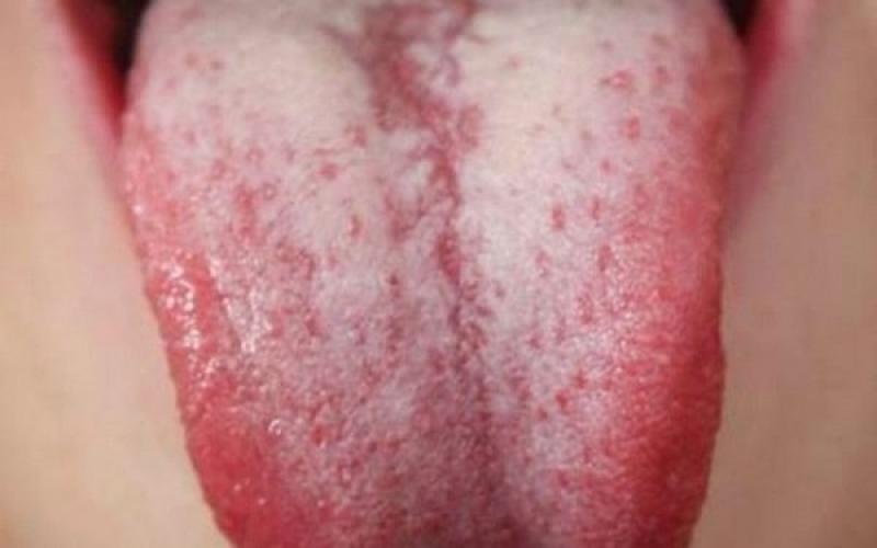 Lưỡi của tôi bị trắng, tôi có thể mắc bệnh gì? Lưỡi của tôi bị trắng, tôi có thể mắc bệnh gì?
