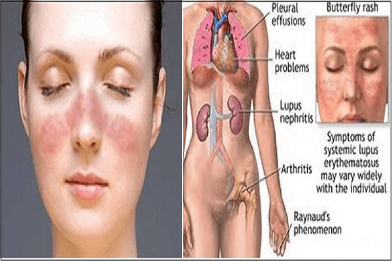 Lupus ban đỏ hệ thống Lupus ban đỏ hệ thống