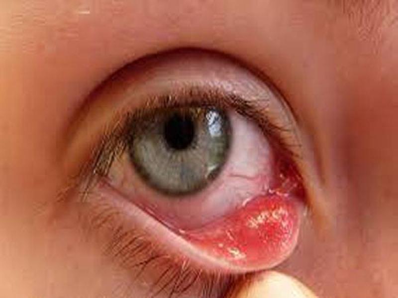 Mắt bị ngứa cộm, đau và hơi đỏ là triệu chứng của bệnh gì