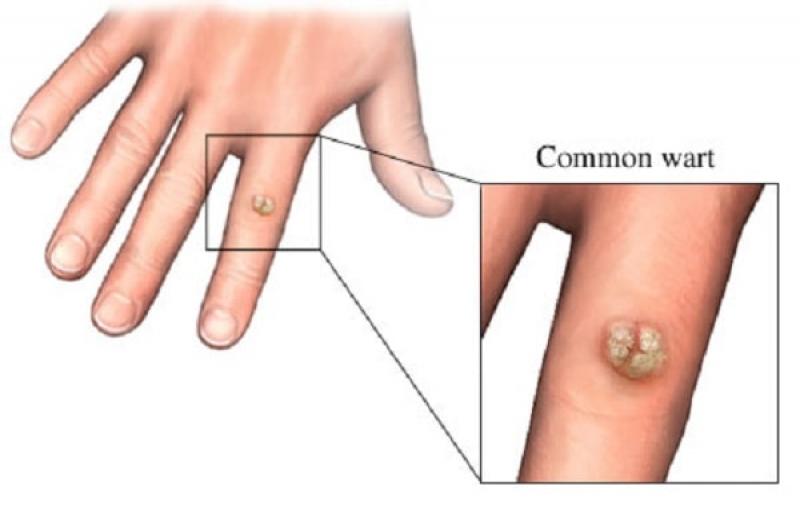 Mụn cóc thông thường Mụn cóc thông thường