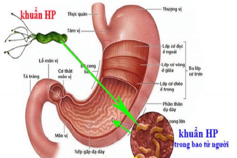 Nguyên nhân của bệnh nhiễm khuẩn Helicobacter Pylori 