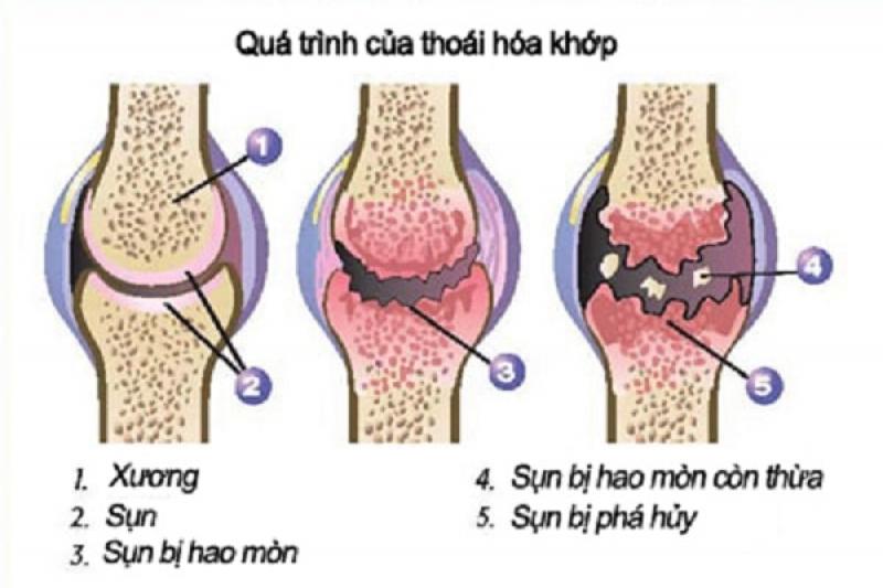 Nguyên nhân của bệnh thoái hóa khớp gối
