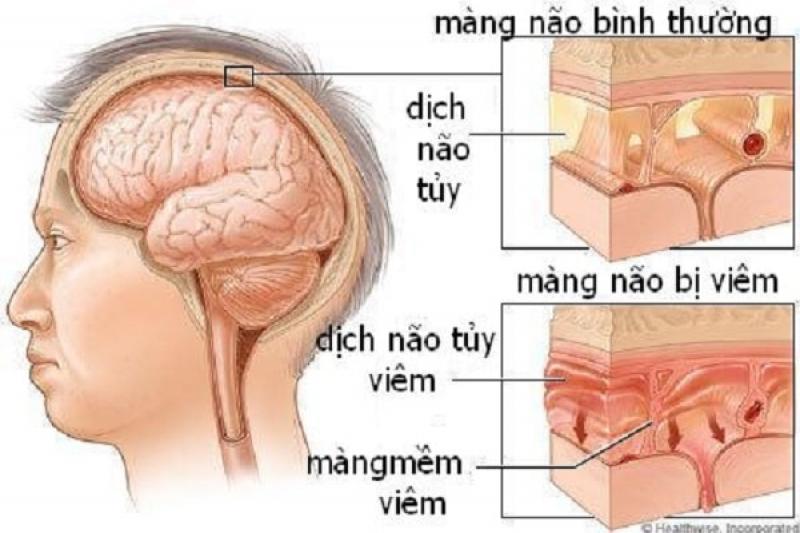 Nguyên nhân của bệnh u màng não