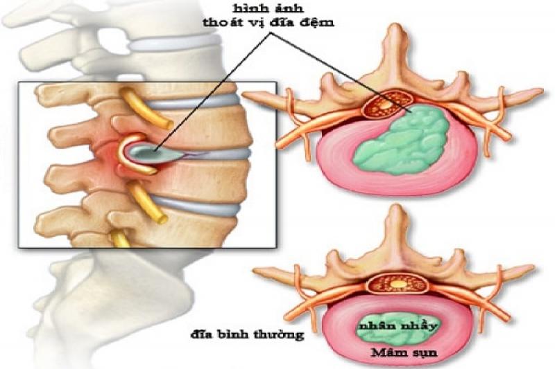 Nguyên nhân gây bệnh thoát vị đĩa đệm cột sống là gì Nguyên nhân gây bệnh thoát vị đĩa đệm cột sống là gì