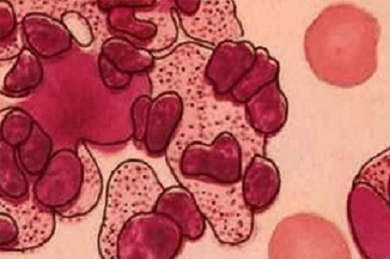 Nguyên nhân gây ra bệnh Lupus ban đỏ hệ thống Nguyên nhân gây ra bệnh Lupus ban đỏ hệ thống