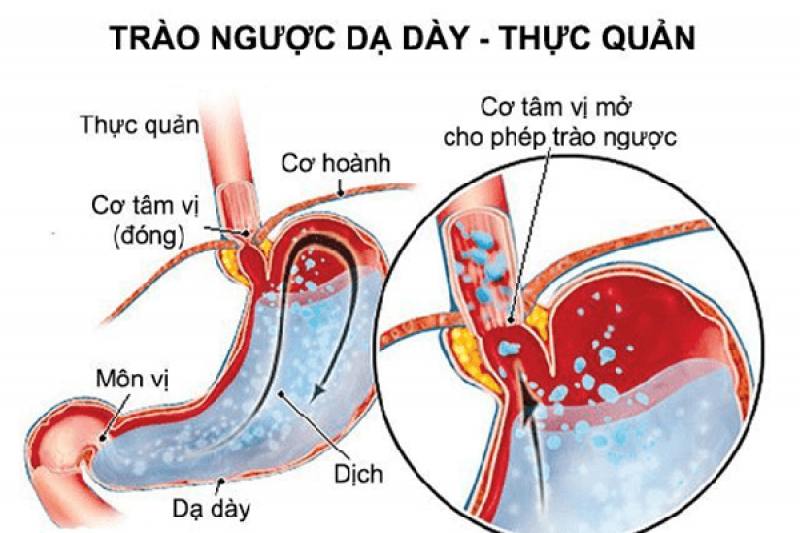 Nguyên nhân gây ra bệnh trào ngược thực quản