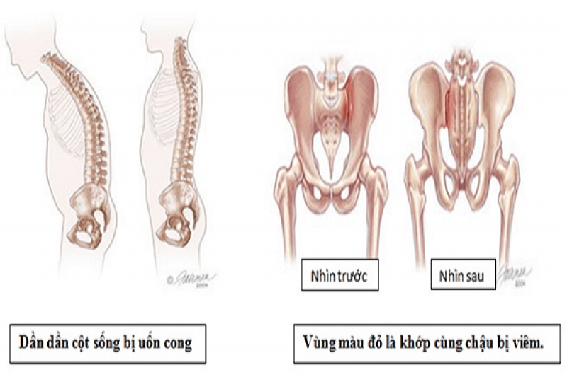 Nguyên nhân gây ra bệnh viêm cột sống dính khớp