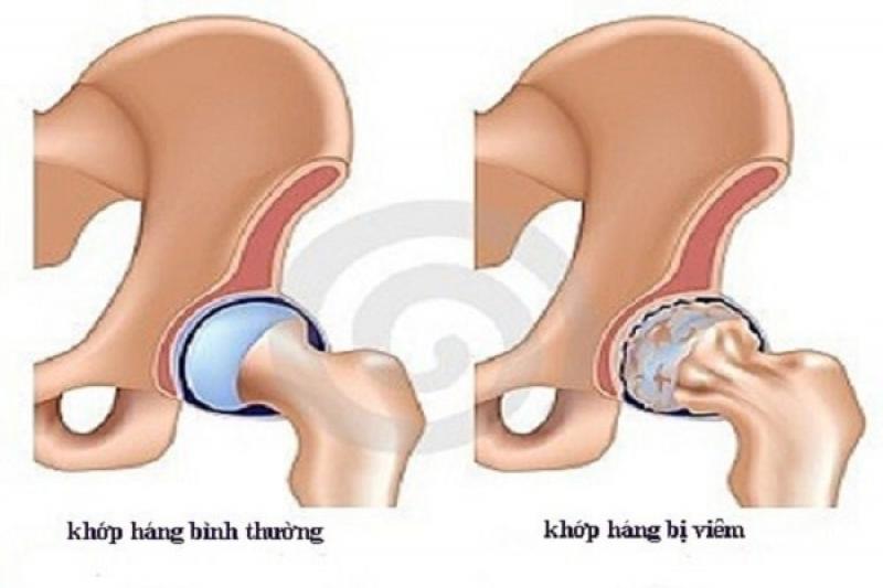 Nguyên nhân gây ra bệnh viêm khớp háng Nguyên nhân gây ra bệnh viêm khớp háng