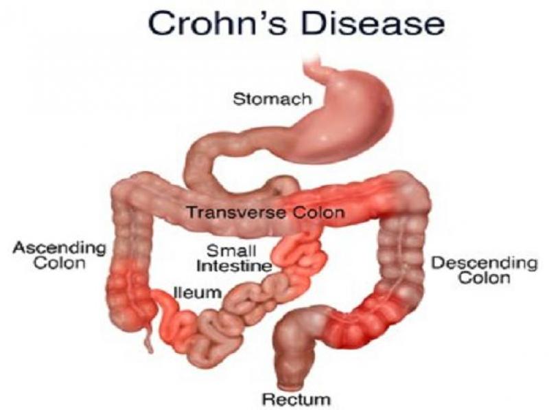Nguyên nhân gây ra bệnh viêm ruột Crohn, viêm ruột từng vùng Nguyên nhân gây ra bệnh viêm ruột Crohn, viêm ruột từng vùng