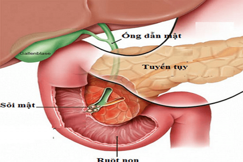 Nguyên nhân gây ra bệnh viêm tụy là gì