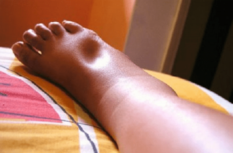 Nguyên nhân gây ra triệu chứng phù chân, cách chữa trị