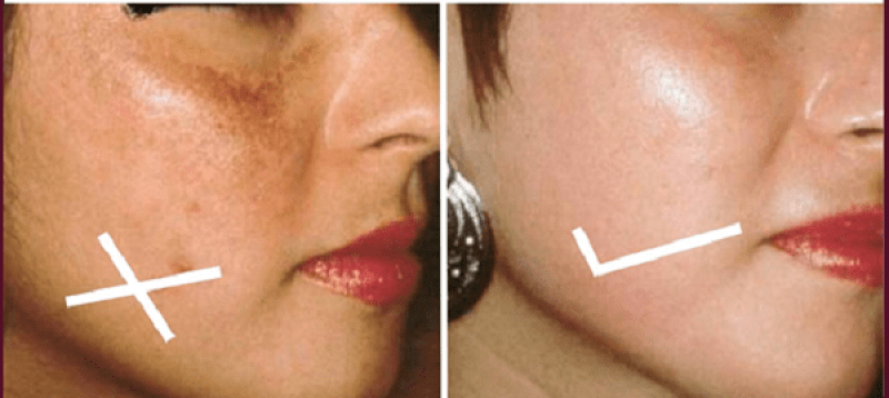 Nguyên nhân khiến da bị sạm và cách chữa trị