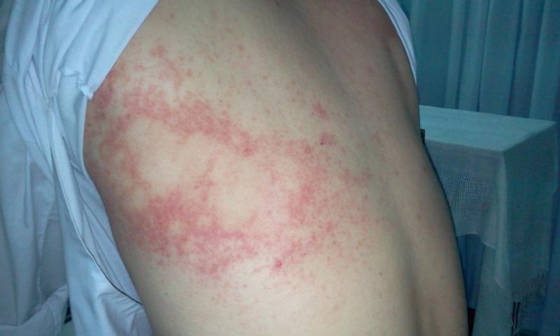 Nhiễm sán Nhiễm sán
