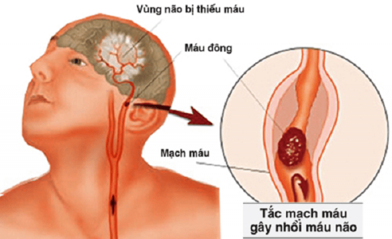 Nhồi máu não Nhồi máu não