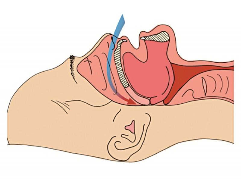 Những điều bạn cần biết về hội chứng ngưng thở khi ngủ