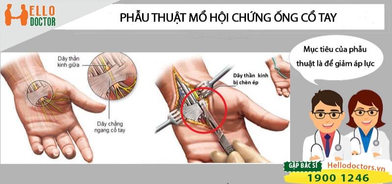Những điều cần biết trong phẫu thuật mổ hội chứng ống cổ tay