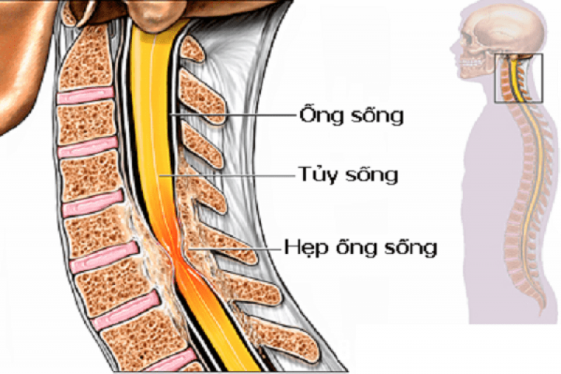 Những nguyên nhân dẫn đến bệnh thoát vị đĩa đệm