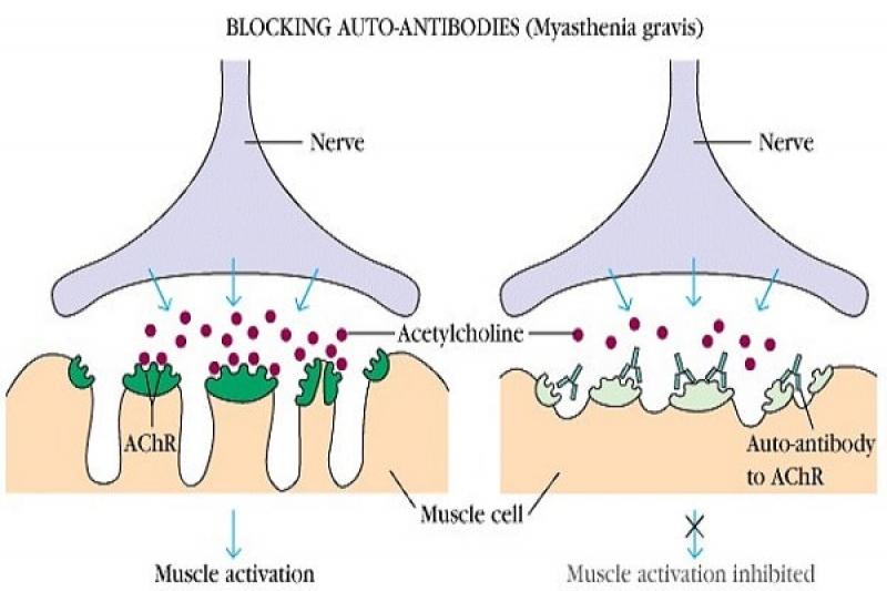 Những nguyên nhân gây nên bệnh nhược cơ Những nguyên nhân gây nên bệnh nhược cơ