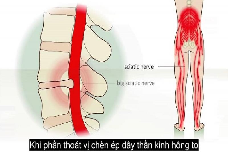 Những nguyên nhân gây ra bệnh đau thần kinh tọa