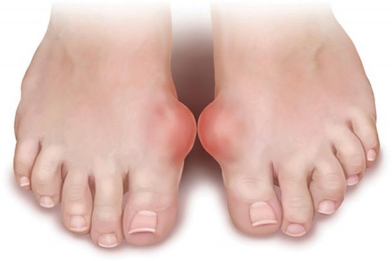 Những nguyên nhân gây ra bệnh Gout