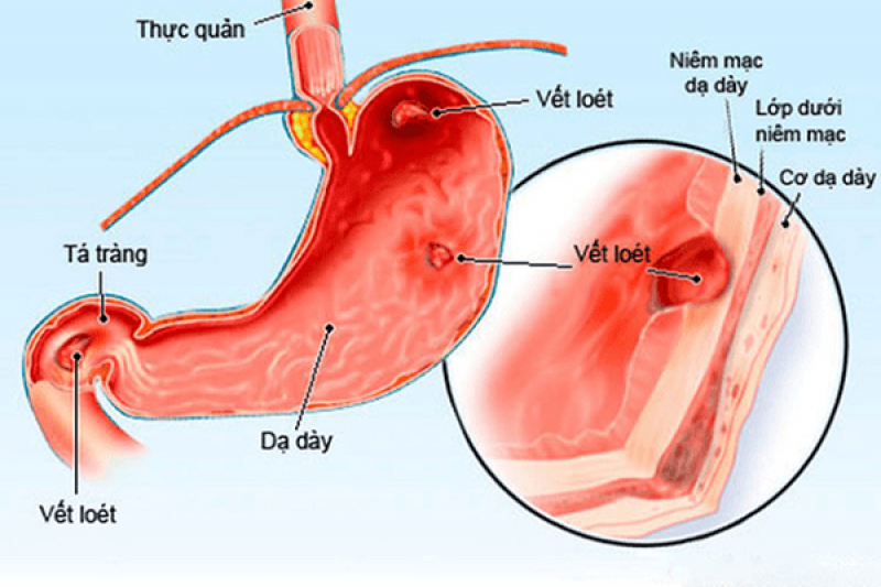 Những nguyên nhân gây ra bệnh viêm loét dạ dày tá tràng