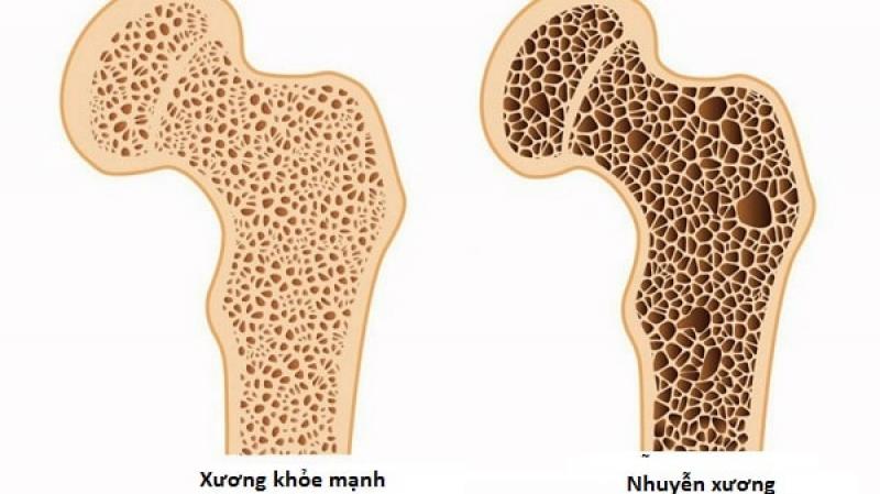 Nhuyễn xương Nhuyễn xương
