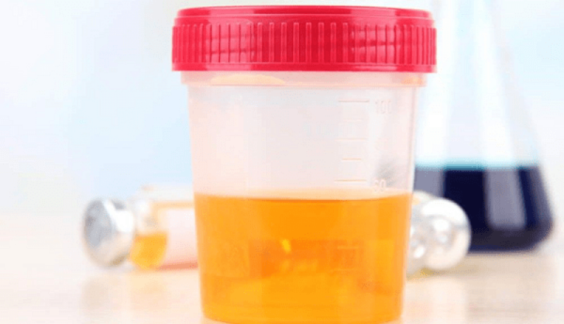 Nước tiểu màu vàng sẫm là dấu hiệu của bệnh gì?