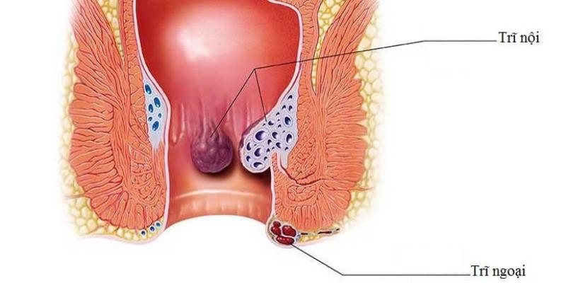 Phân loại và nguyên nhân gây ra bệnh trĩ