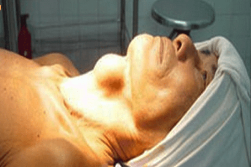 Phẫu thuật bướu cổ và những điều bạn cần biết
