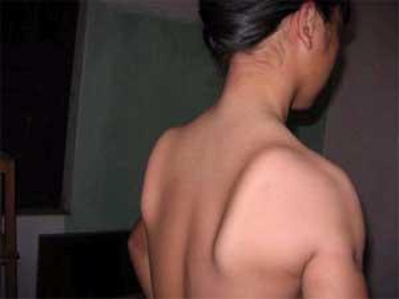 Phẫu thuật teo cơ Delta