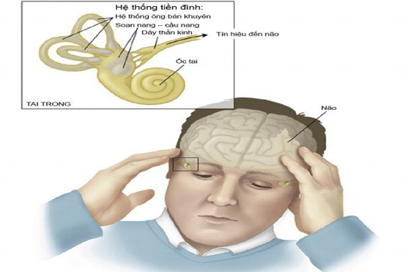 Phòng tránh bệnh rối loạn tiền đình cần lưu ý những gì