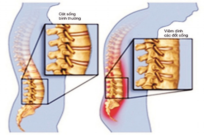 Các cách điều trị và chữa bệnh viêm cột sống dính khớp