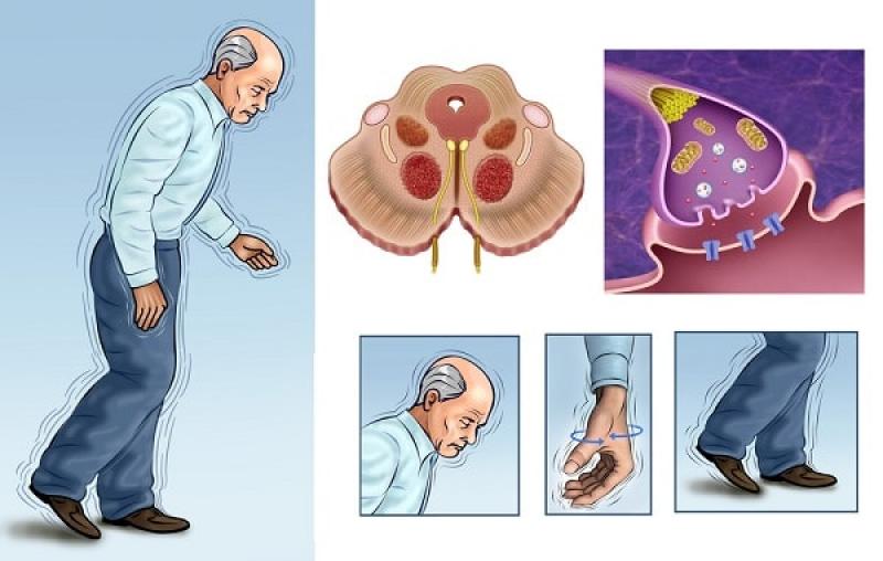 Rối loạn vận động