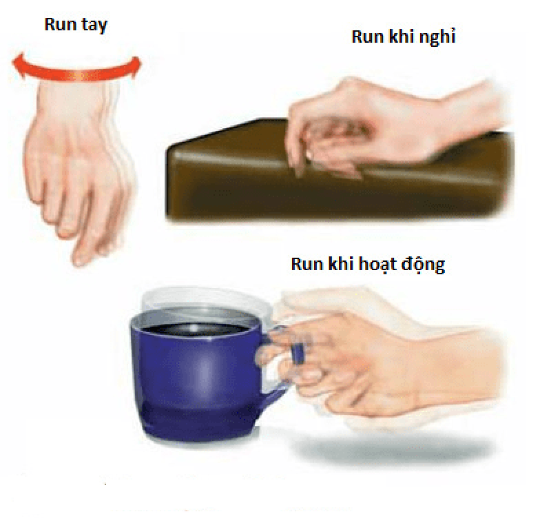 Run tay là biểu hiện của bệnh gì? Nguyên nhân và cách điều trị