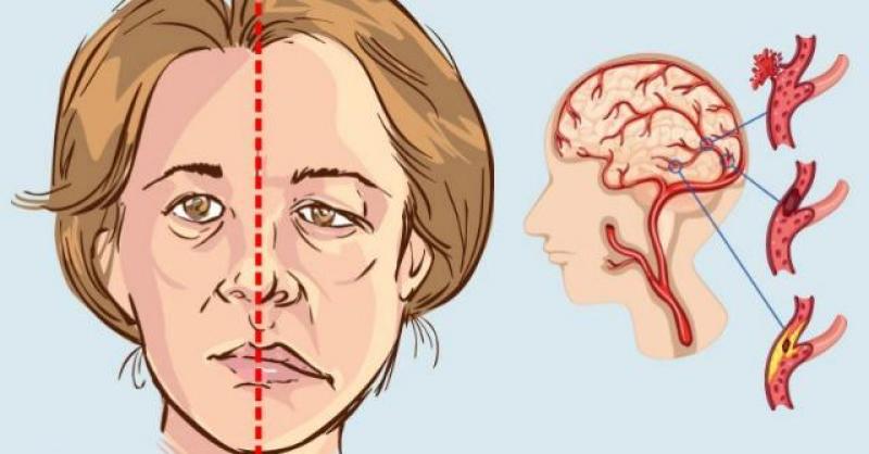 Sơ cứu tai biến mạch máu não