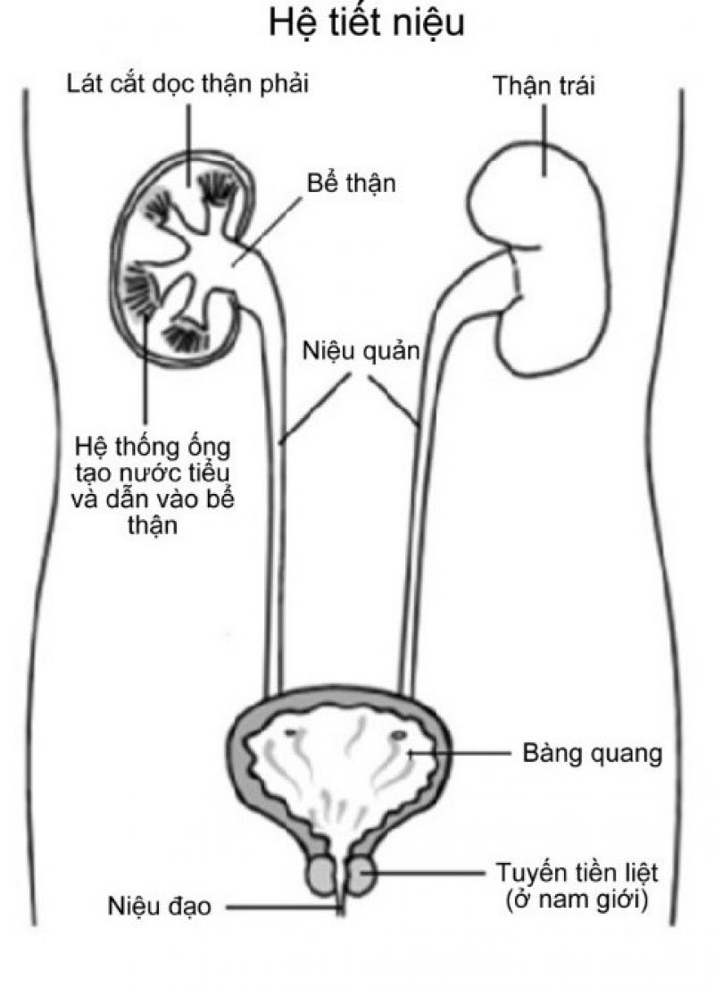 Sỏi thận