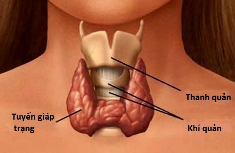 Suy giáp - biến chứng thường gặp sau phẫu thuật cắt tuyến giáp