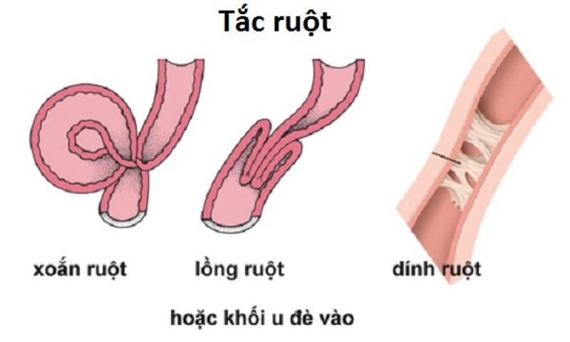 Tắc ruột