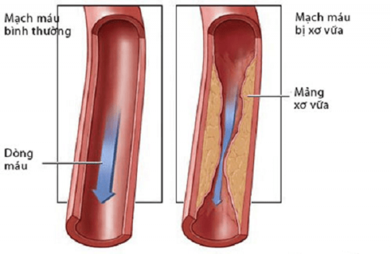 Tăng Cholesterol máu gia đình