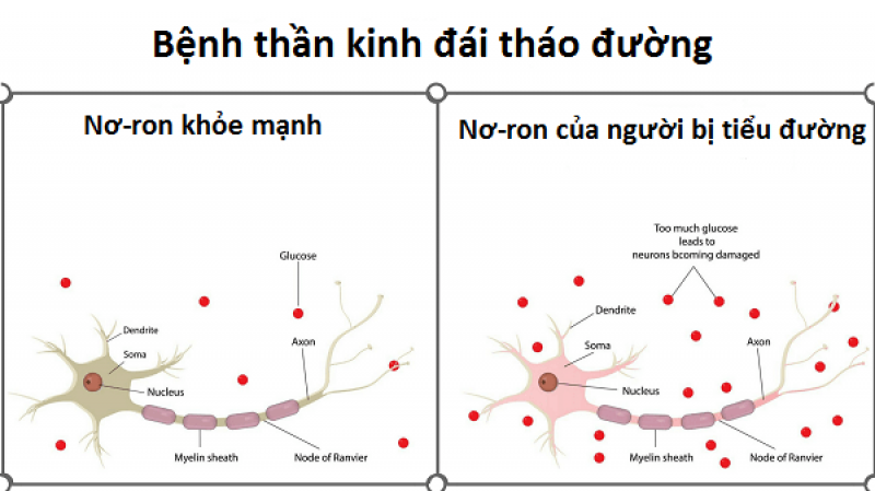 Thần kinh đái tháo đường