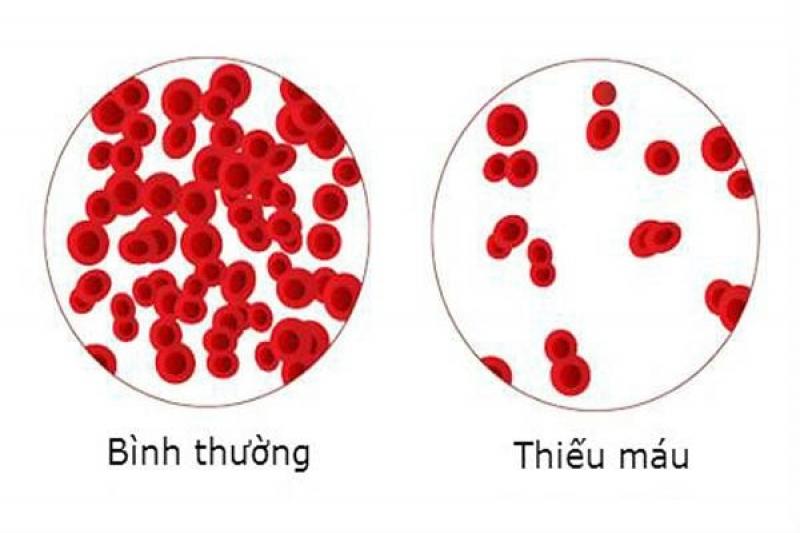 Thiếu máu là dấu hiệu của bệnh gì, biểu hiện và cách chữa trị Thiếu máu là dấu hiệu của bệnh gì, biểu hiện và cách chữa trị