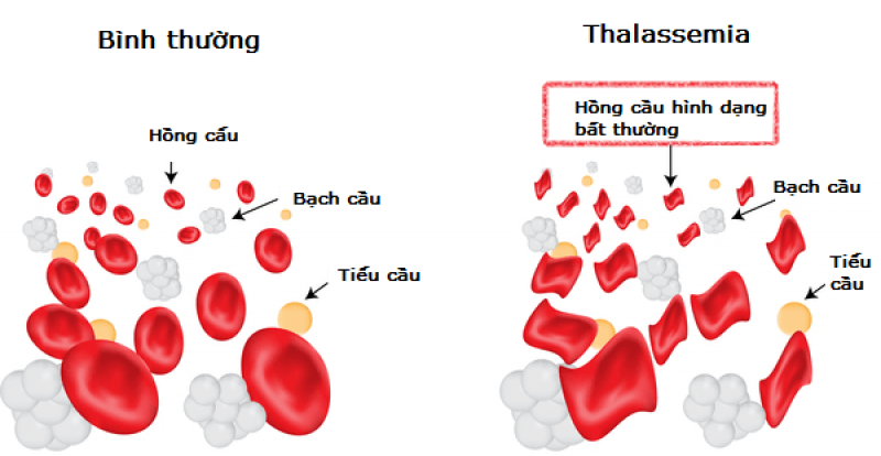 Thiếu máu Thalassemia
