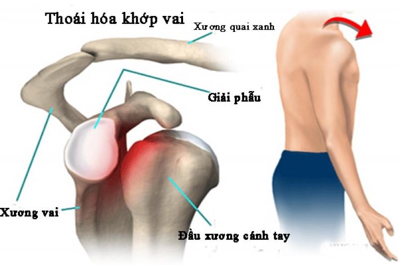 Thoái hóa khớp vai