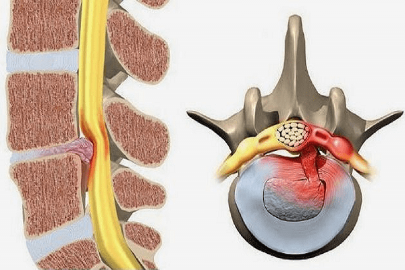 Thoát vị đĩa đệm cột sống thắt lưng