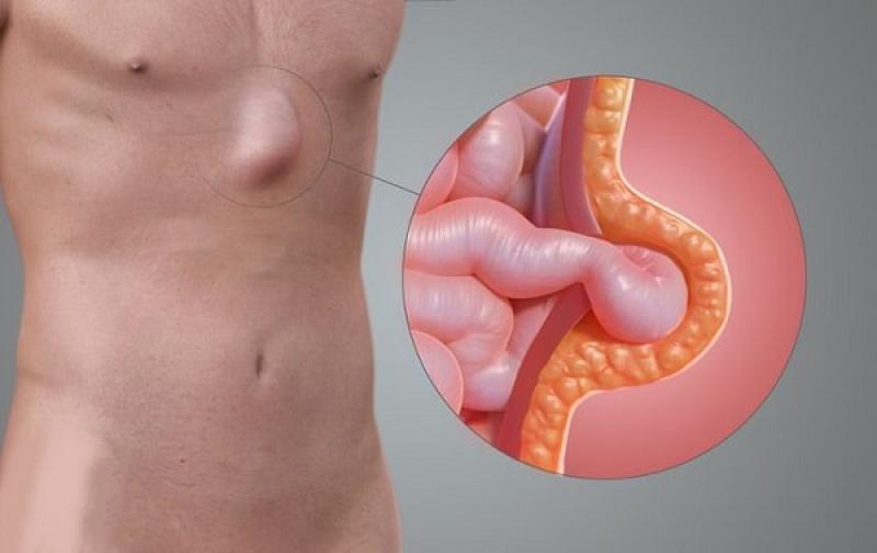 Thoát vị rốn