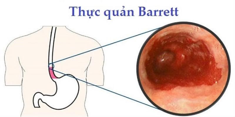 Thực quản Barrett
