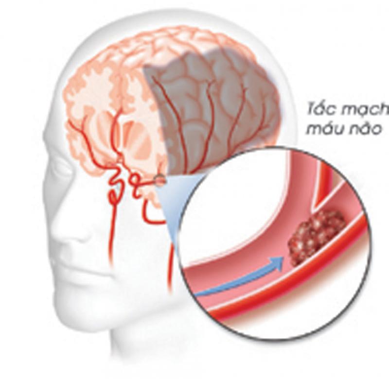 Thuốc chống tai biến mạch máu não
